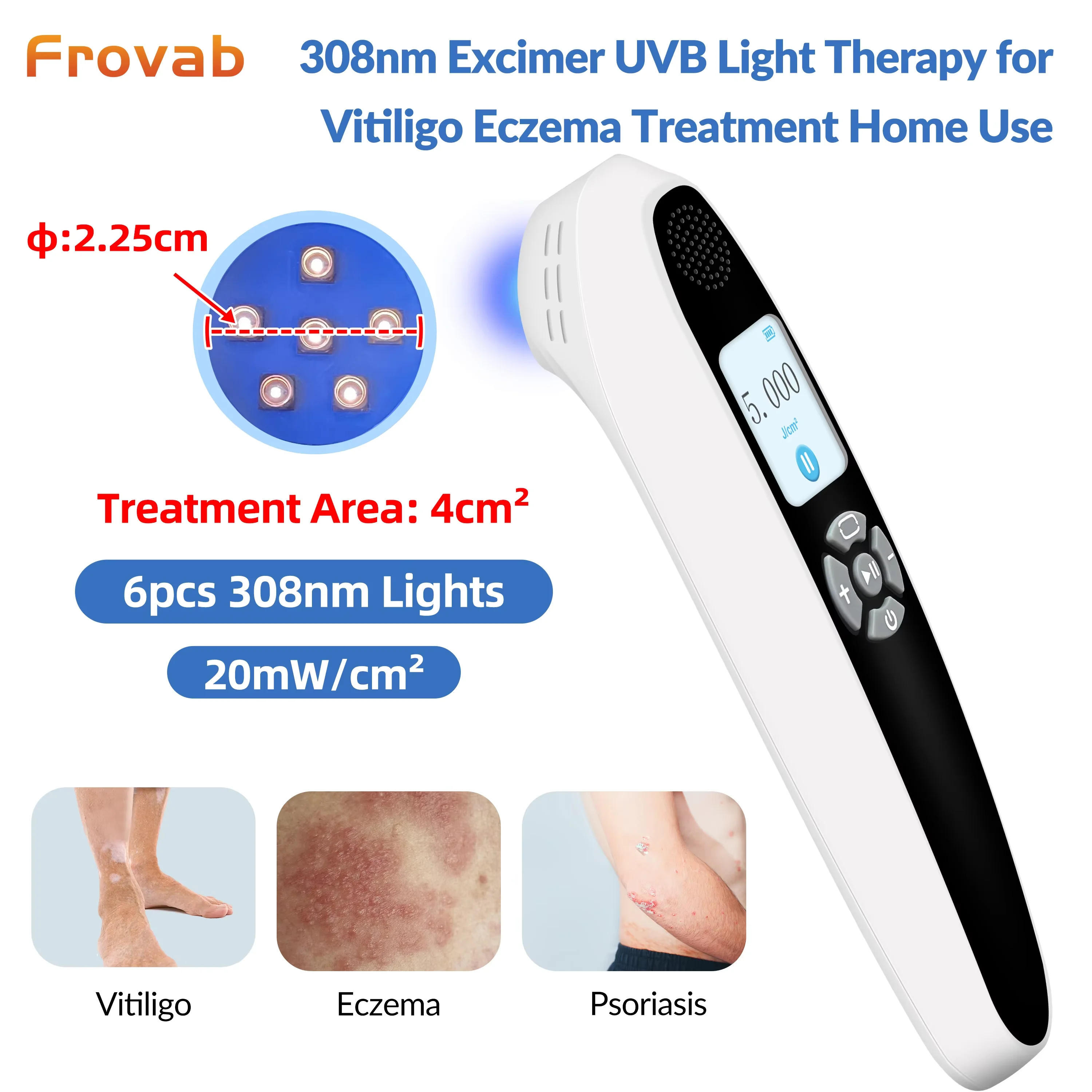

UVB 308nm Household Ultraviolet Phototherapy Instrument, Vitiligo Treatment for Therapy, Psoriasis, Skin Disease