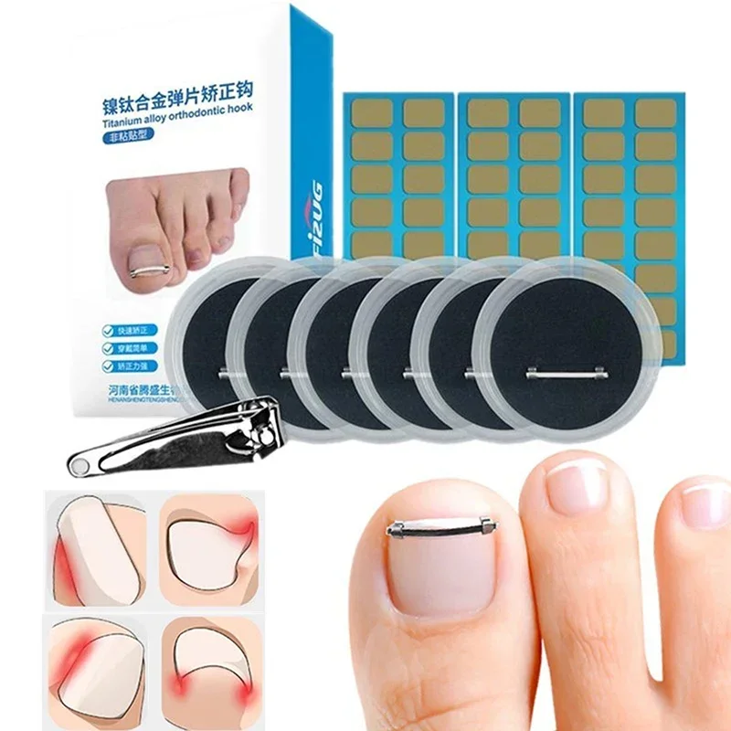 Strumento per pedicure dell'unghia del piede incarnita incorporato Cura delle unghie dei piedi Raddrizzamento Clip di correzione Morsetto curvo Strumento di correzione delle unghie dei piedi per le dita dei piedi