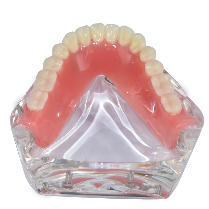 Dental Overdenture Teeth Model Superior Upper/lower Jaw Demo Model with Removable Bridge 4 Implants Restoration Teaching Study