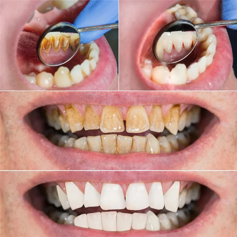 

INLIG-Электрическая зубная щетка, 5 режимов передачи, беспроводной налет, органический набор для отбеливания зубов, зеркало для скалера зубного камня