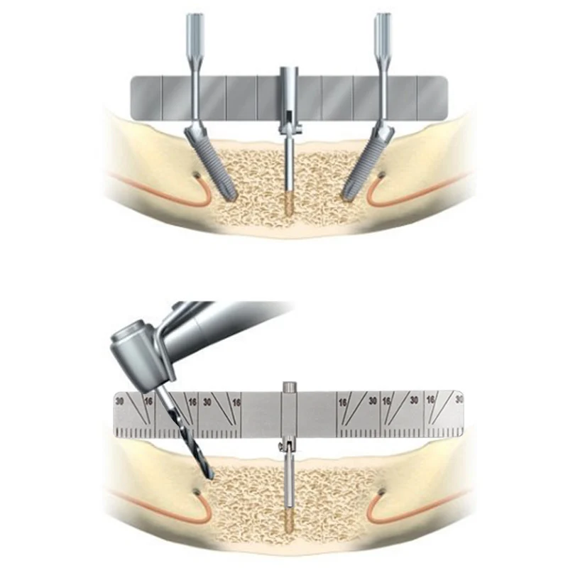 

Dental Surgical Planting Positioning Locator Angle Ruler Bendable Implant Locating Guide Guage Autoclavable Dentistry Material