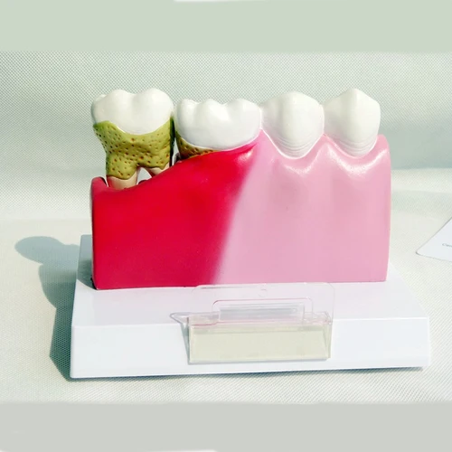 Imagen 2 del producto Modelo de dientes de caries de anatomía Dental, aparatos dentales extraíbles, enseñanza de anatomía y estructura de dientes enfermedades, herramienta de odontología