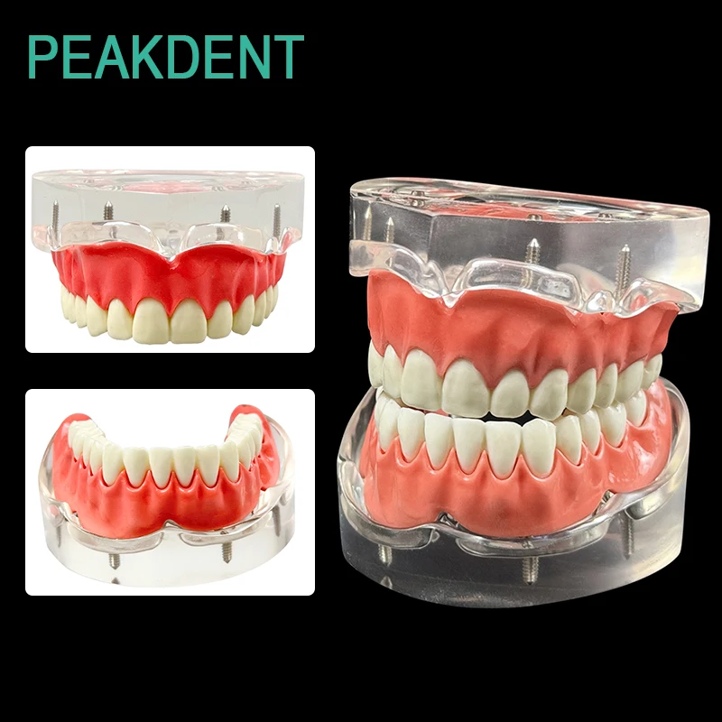 

Модель зубного протеза для восстановления зубов с 4 гвоздями для верхней и нижней части челюсти, модель имплантации, обучающая демонстрация