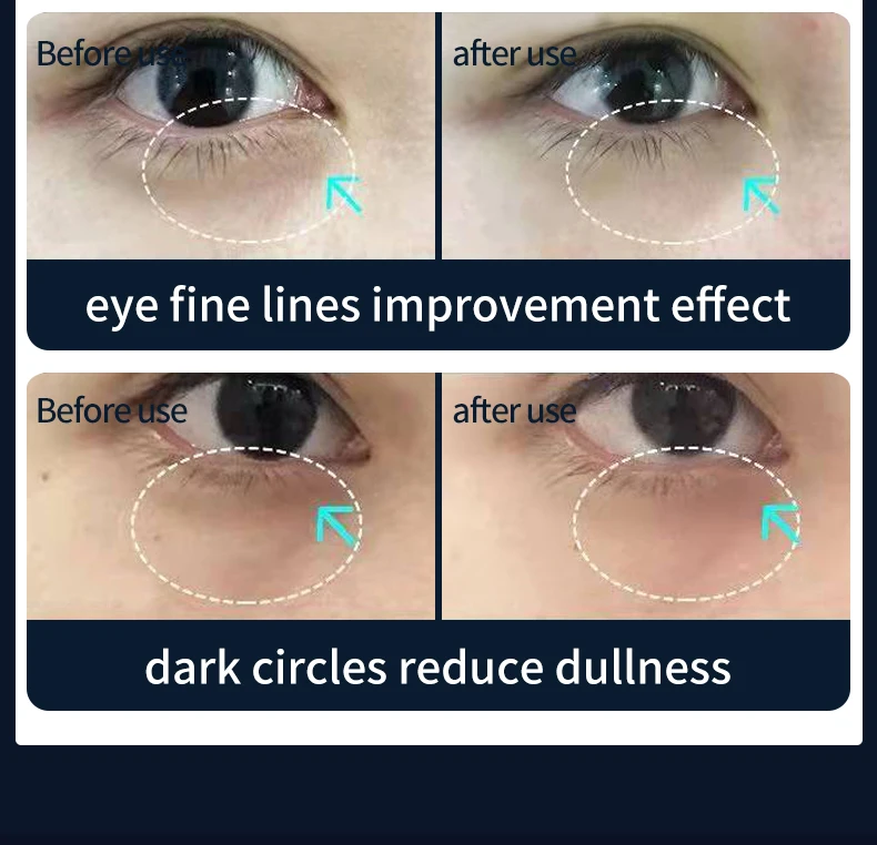 ミスモン MS-316C ポータブル美容器 家庭用 フェイスリフト 若返りデバイス しわ除去 目元ケア