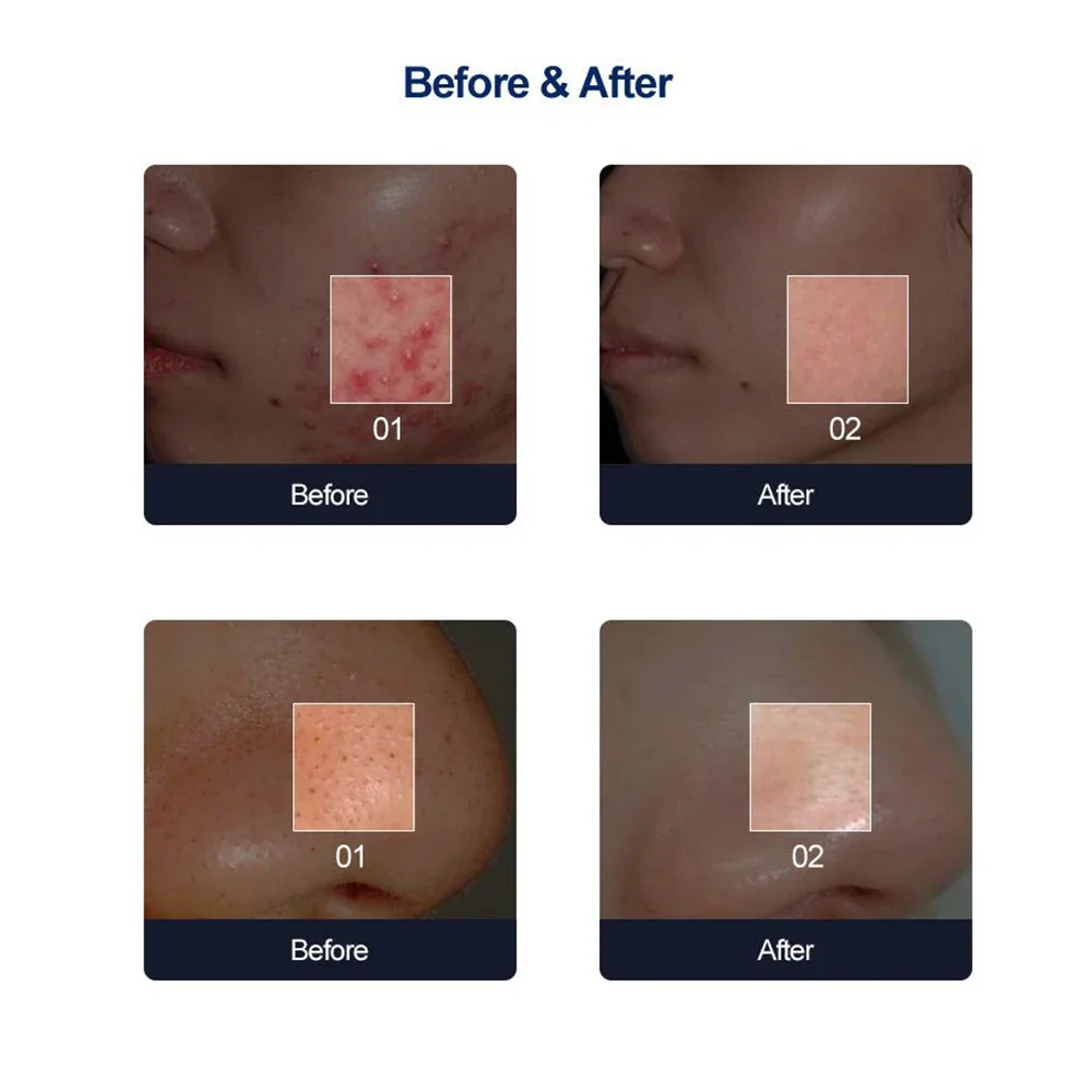 6-9 Spitzen Diamant-Dermabrasionskopf Mikrodermabrasions-Exfoliator Gesichts-Dermabrasionsgerät für Zuhause Dermabrasions-Ersatzköpfe – Detail 8