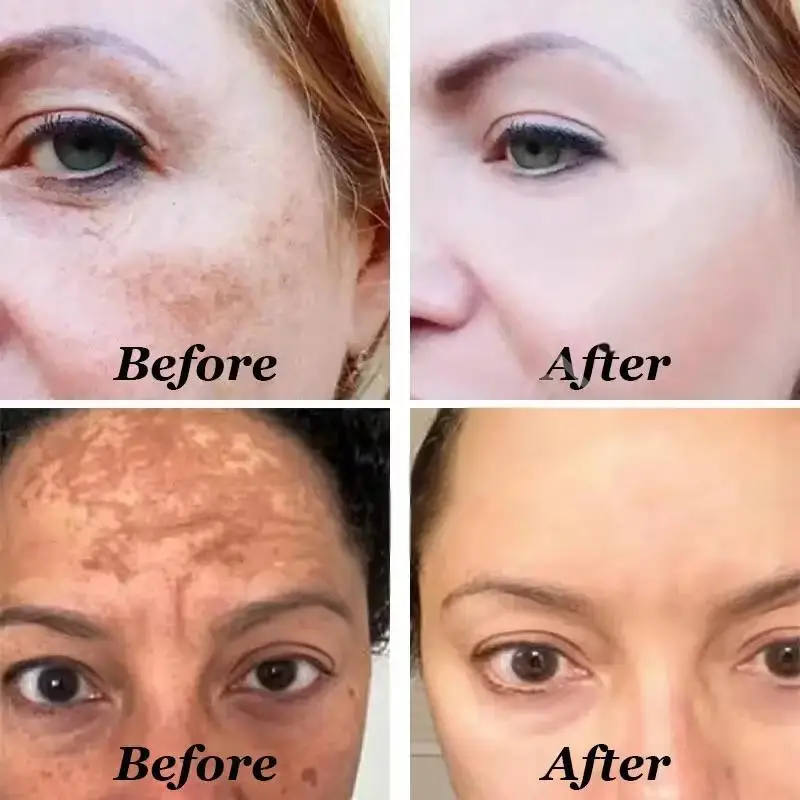 Vitamina c remover manchas escuras soro clareamento anti-rugas ageless firme cuidados com a pele desvanece-se melanina iluminando tom da pele cosméticos