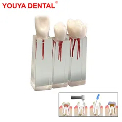 3pcs Dental Teaching Model Endodontic Treatment Teeth Model For Studying Training Practice Root Canal Block Endo Pulp Cavity RCT