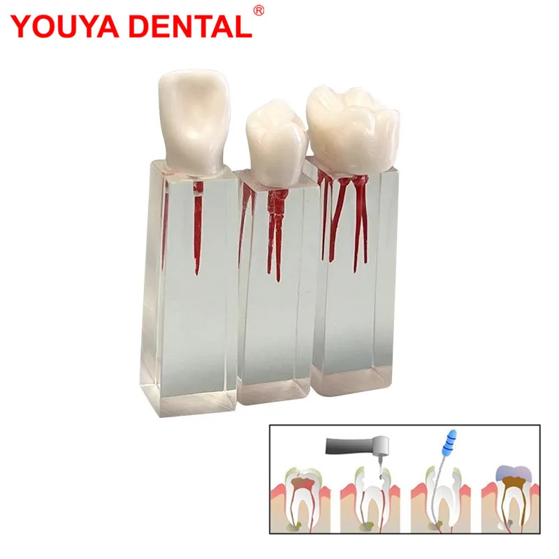 3pcs Dental Teaching Model Endodontic Treatment Teeth Model For Studying Training Practice Root Canal Block Endo Pulp Cavity RCT