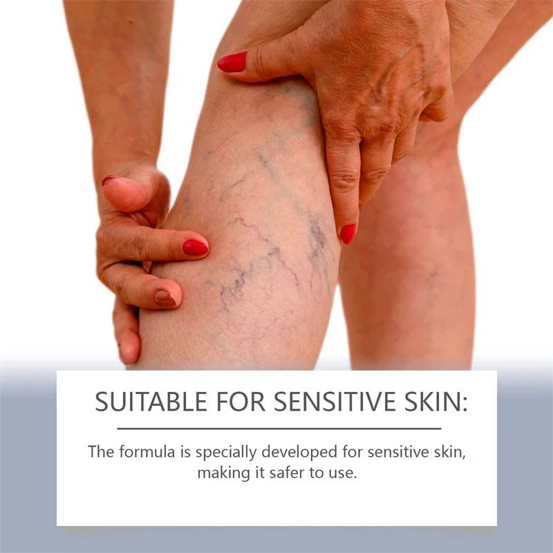 Krem regenerujący żylaki Relaksujące nogi Łagodzi naczyń krwionośnych Łagodzi zapalenie naczyń Zapalenie żył Krem leczniczy pająka w bólu obrzęków