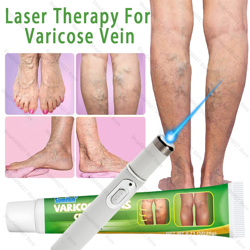 Лазерная терапия для лечения варикозного расширения вен эффективное облегчение дислокации ног лечение флебита улучшение циркуляции синего цветов