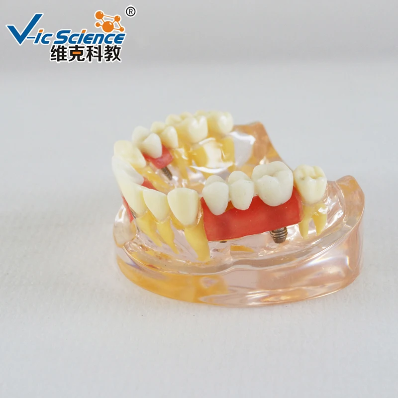Modelo de demonstração de implante Modelo de implante dentário de meia boca