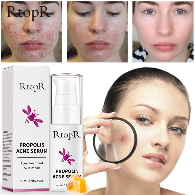 RtopR 20ML Propolis Acne Serum Acne Scar Repair Cream Spot Cleansing Essence Pore Reduction Oil Control Brightening Hydration