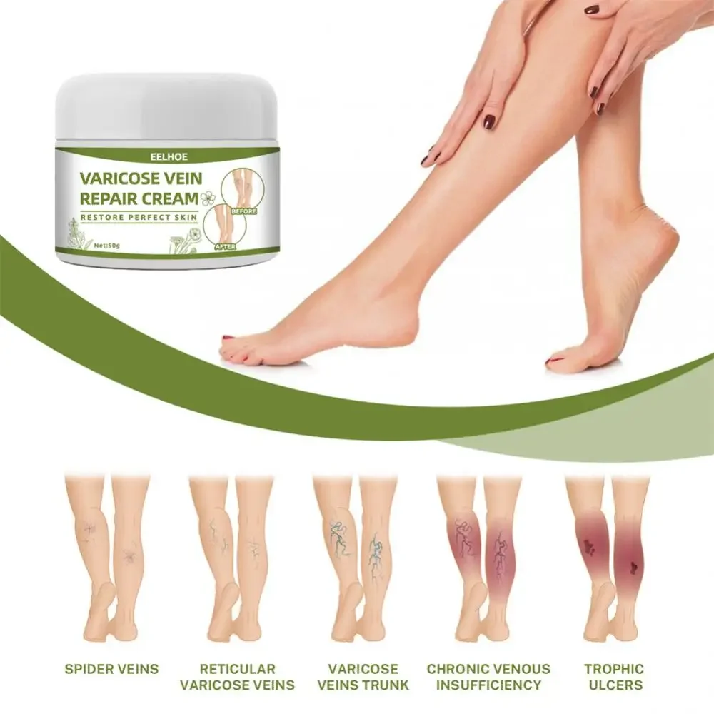 Crema riparatrice per vene varicose Spray riparatore Allevia il dolore alle gambe Gonfiore Migliora lombrico delle gambe Rigonfiamento varicoso Aumenta la circolazione sanguigna