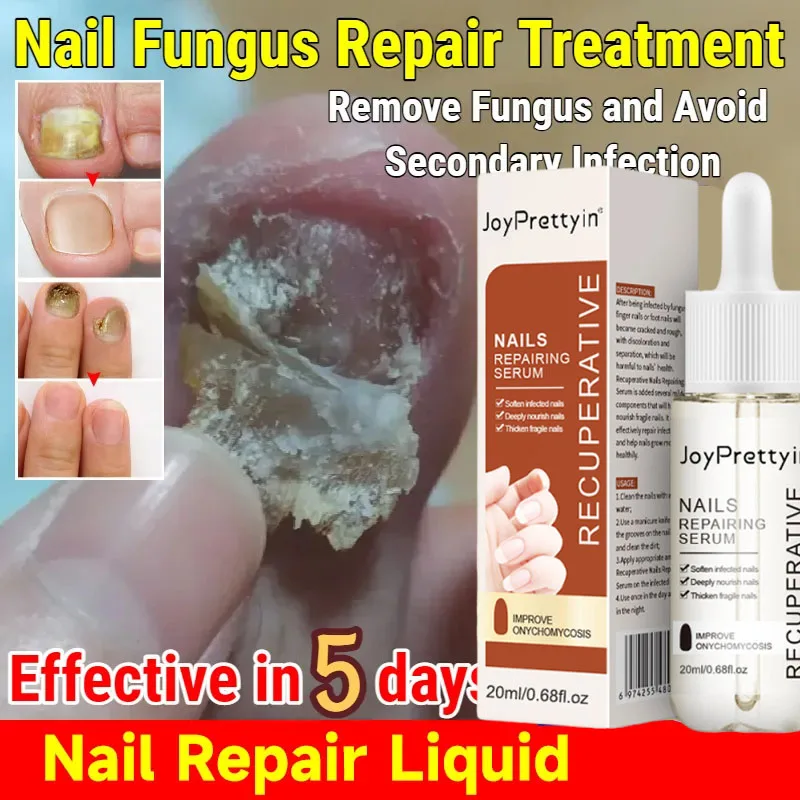 爪真菌治療エッセンス爪真菌症を除去修復損傷した爪を修復抗足指感染症ジェル足クリーム除去爪真菌