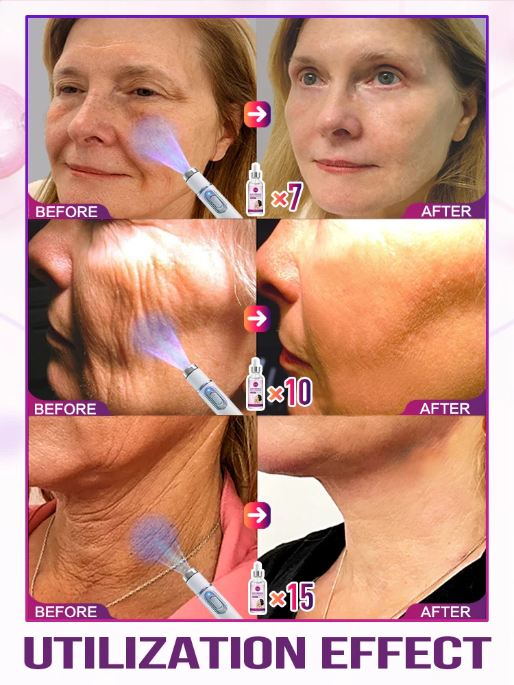 Laser Product For Solves wrinkle Problems