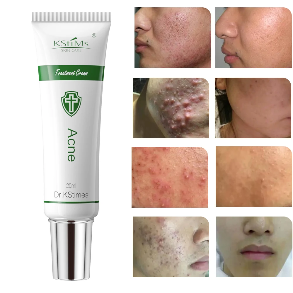 Herbal Extract Whitening Anti Freckle Cream Acne Face Bleaching Skin Lightening Cream for Dark Skin Women Glowing Skin