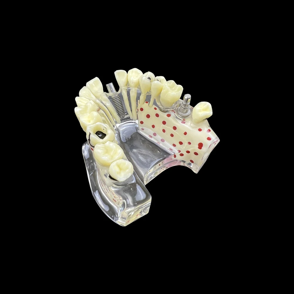 Dental Implant Model Maxillary Tooth Model With Dental Bridge And Caries Dental Teaching Mold Demo Student Practice Product