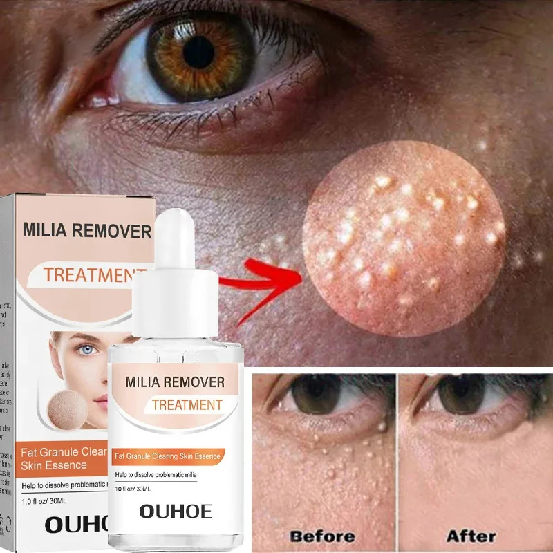 Effective Removal Fat Granules Eye Serum Anti Dark Circle Eye Bags Fade Fine Line Essence Anti-puffiness Moisturizing Skin Care