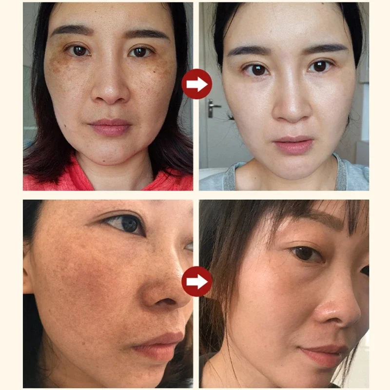 Nicotinamide Freckle Removal  Serum Attenuates Stains Facial Salicylic Acid Shrinks Pores  Moisturizes Face Skin Care Products