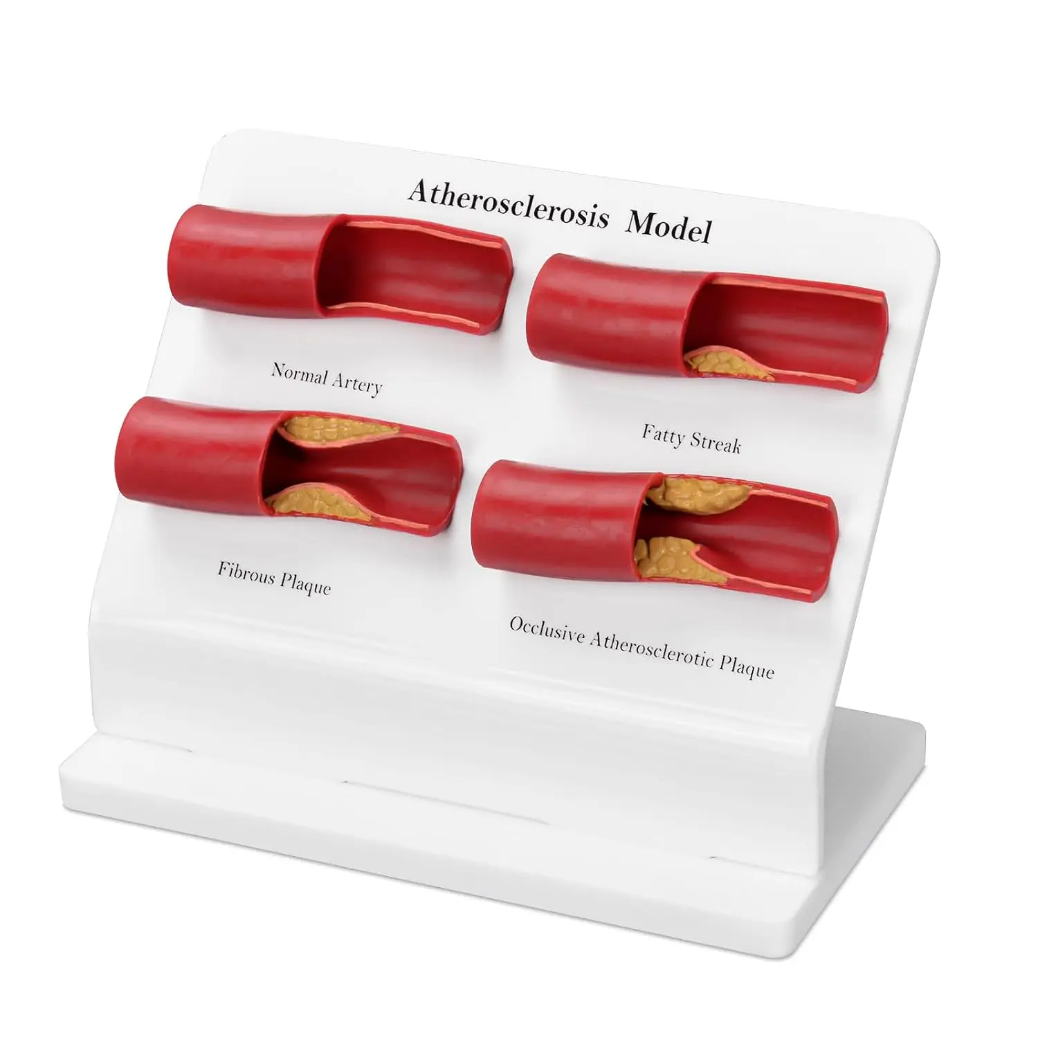 Lifelike Atherosclerosis Model Artery Plaque Display Vascular Disease Plaque Buildup Lumen Narrowing for Medical Education