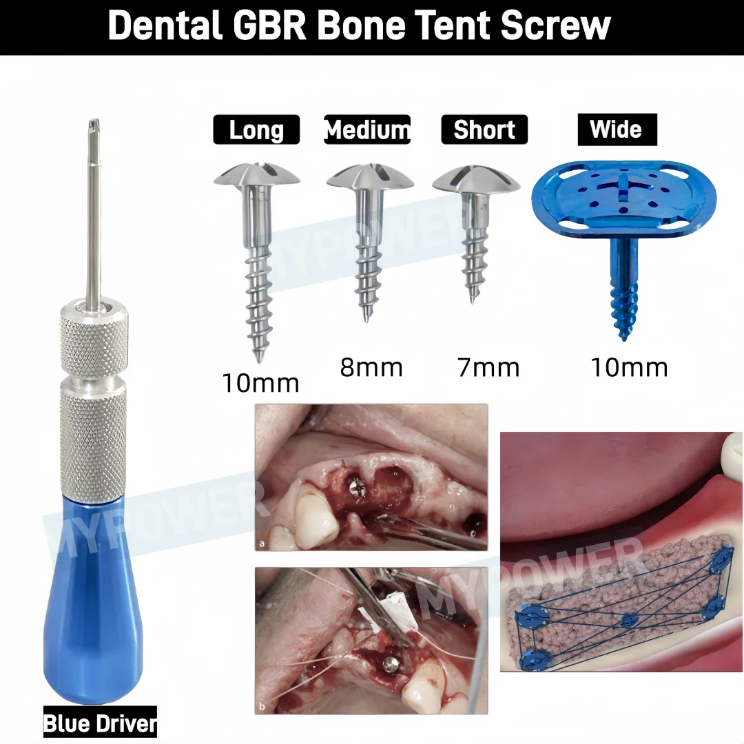 New Dental GBR Bone Screw Tent Screw Tacks Universal Handle Tip Guide Bone Regeneration Membrane Tenting Blue Screwdriver L/M/S