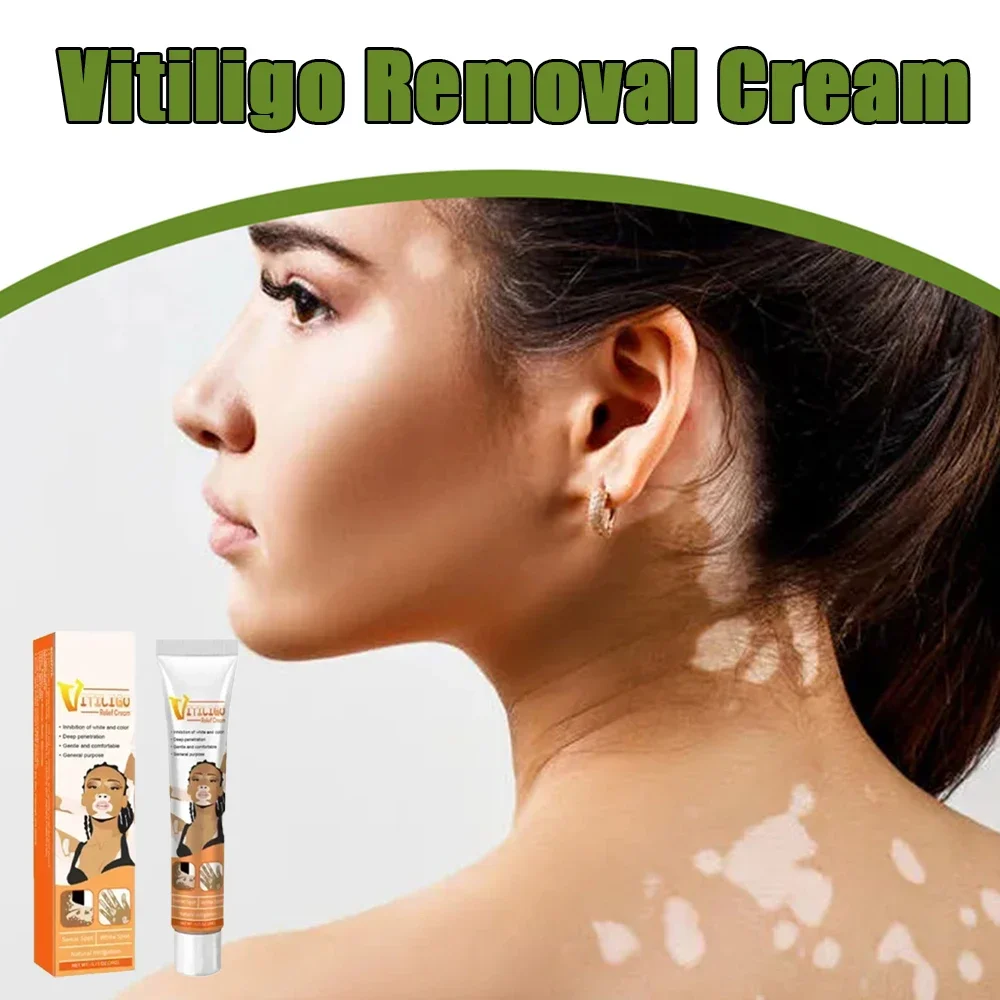

Advanced Vitiligo Care Cream White Spots Reduction Formula for Skin Effective Spot Remover