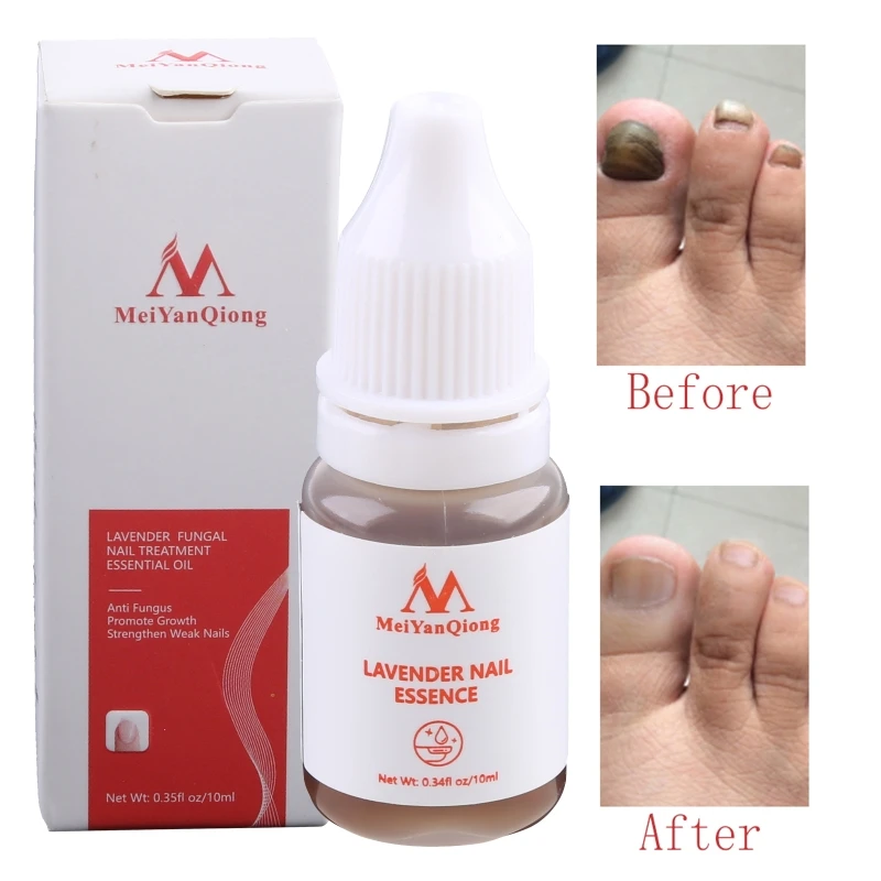 E1YE Repair Essence เซรั่มเชื้อราเล็บ Onychomycosis กำจัดเล็บ