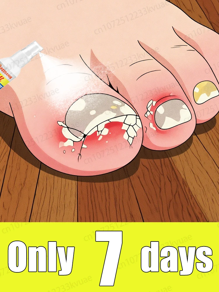 Say goodbye to onychomycosis and restore normal nails.