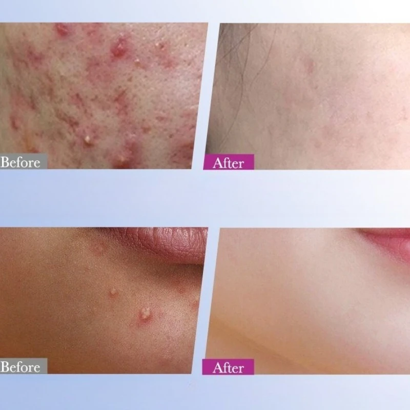 7/8/10/14/16 ورقة ملونة ستار حب الشباب التصحيح غير مرئية حب الشباب غطاء بثرة التصحيح تحسين النساء الجلد الغروانية المائية حب الشباب أدوات العناية