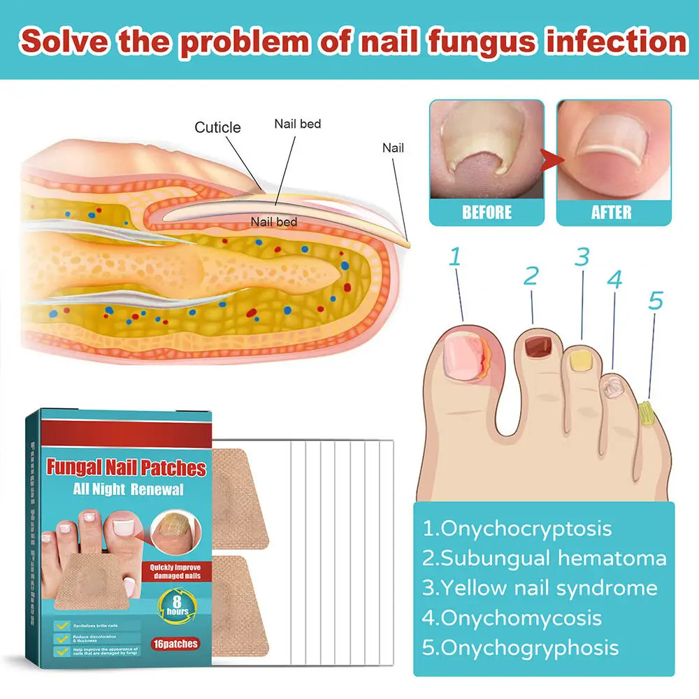 16/32 قطعة القدم مسمار تصحيح ملصق رقعة إصلاح الأظافر الفطرية سماكة لينة علاج الداحس مقاوم للماء لزجة العناية بالقدم #4