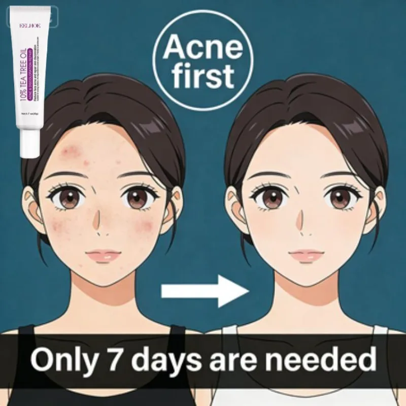 

One course of acne face cream treatment skin care whitening acne face cream efficient skin care package