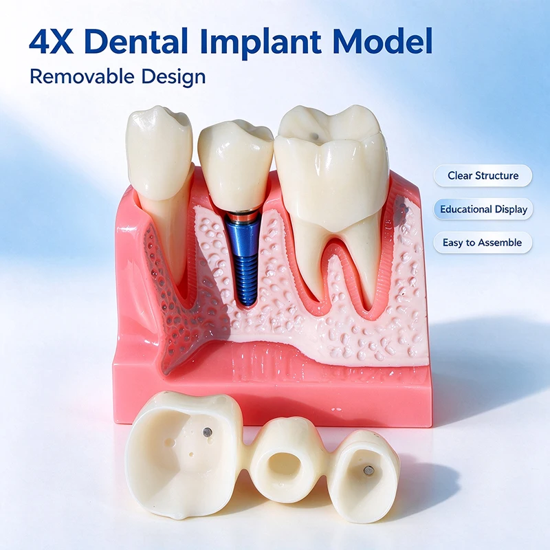 Dental 4x Implant Model, Removable Denture Restoration Implant Model, Used for Teaching Practice and Doctor-Patient Communicatio