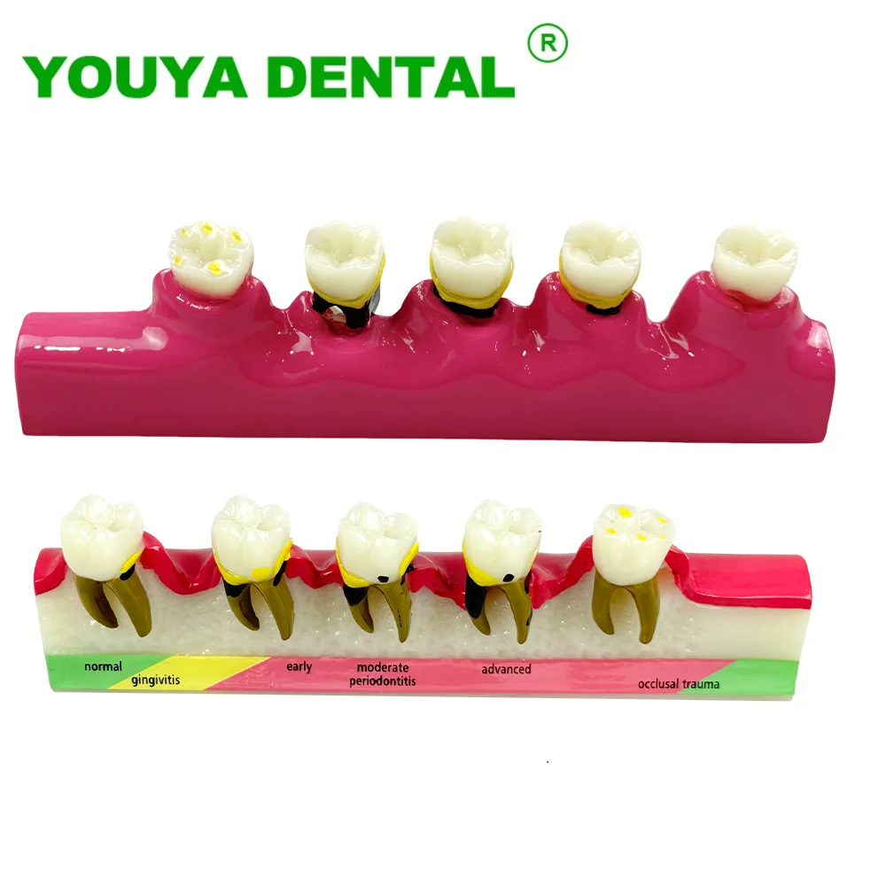 Dental Disease Model Teeth Periodontal Caries Breakdown Display Teaching Tooth Model Dentist Communication Demonstration Tools