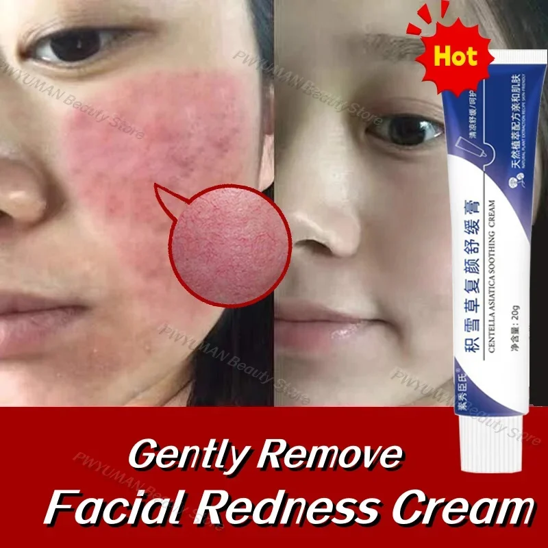 

Repair Facial Redness Cream Effective Soothing Sensitive Skin Fast Treatment Redness Rosacea Itching Moisturizer Korean Cosmetic