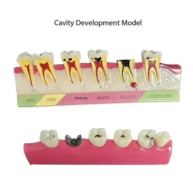 1 Set Dental Oral Caries Comparison Tooth Development Evolution Periodontal Disease Assort Tooth Typodont Teaching Study Model