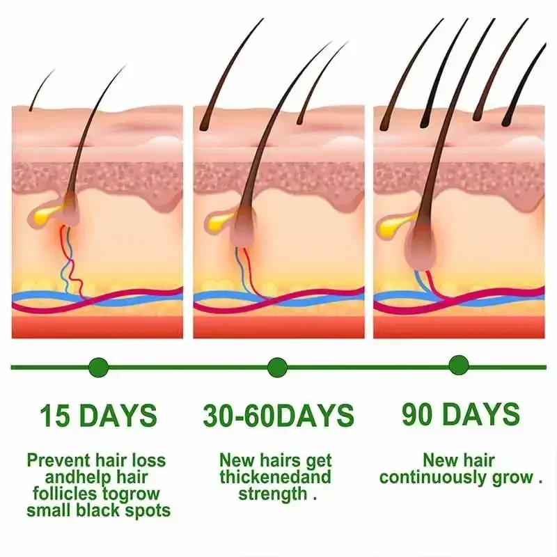 Effectieve Snelle Haargroei Olie Kaalheid Reparatie Erfelijke Postpartum Seborrheic Anti Verlies