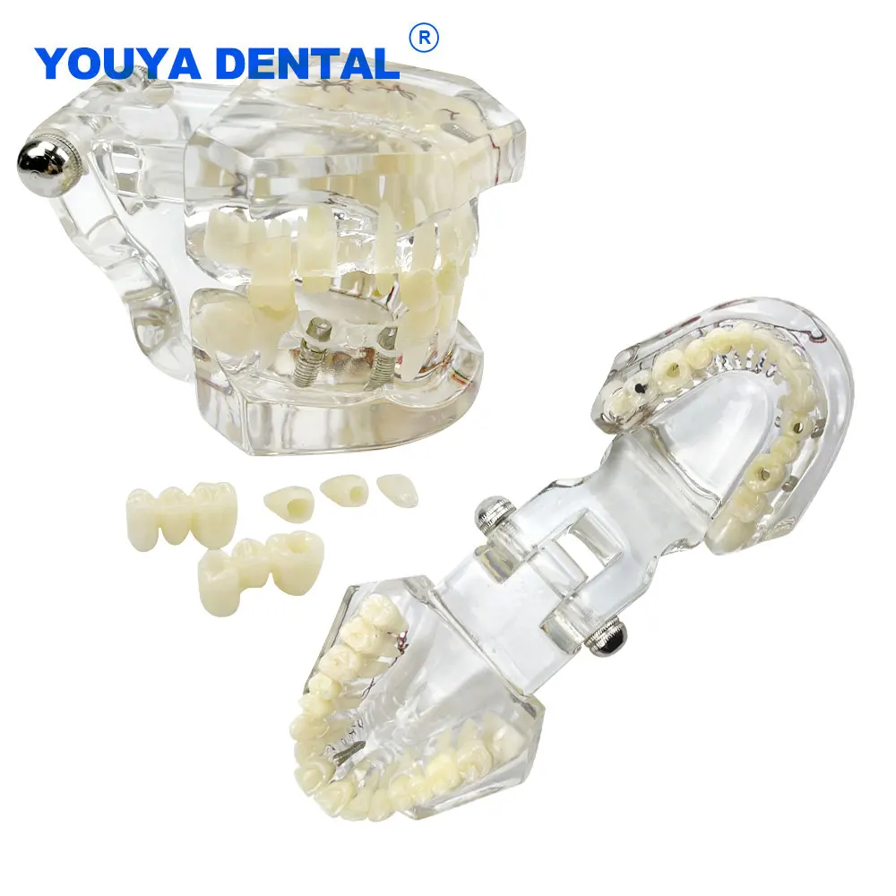 Transparent Disease Teeth Model Typodont Removable Tooth Jaw Model For Studying Research Oral Disease Teaching Demo Medical