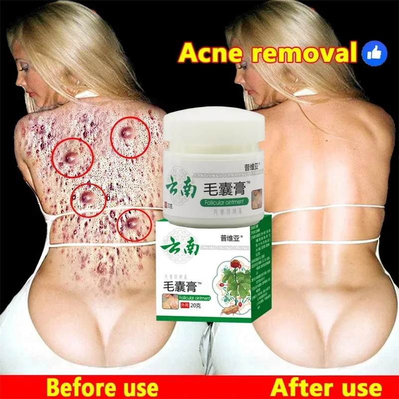 Body Acne Removal Cream Treatment Face Butt Back Acne Marks Smooth Repair Chicken Skin Cream Moisturizing Whitening Skin Care