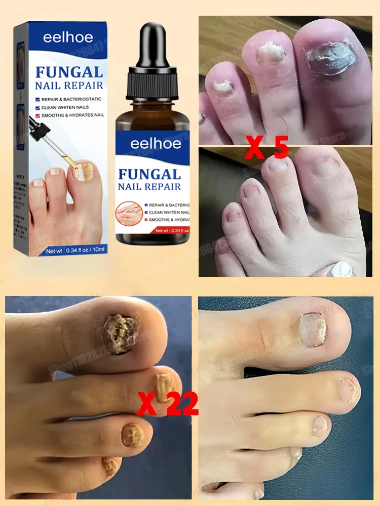 ネイル ファンガス トリートメント エッセンシャル オイル - 7日間で修復