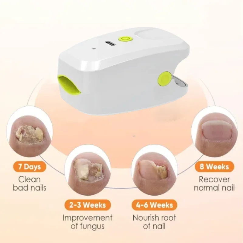 

Professional Laser Nail Care Device for Onychomycosis Treatment and Nail Decay Prevention Home Tool