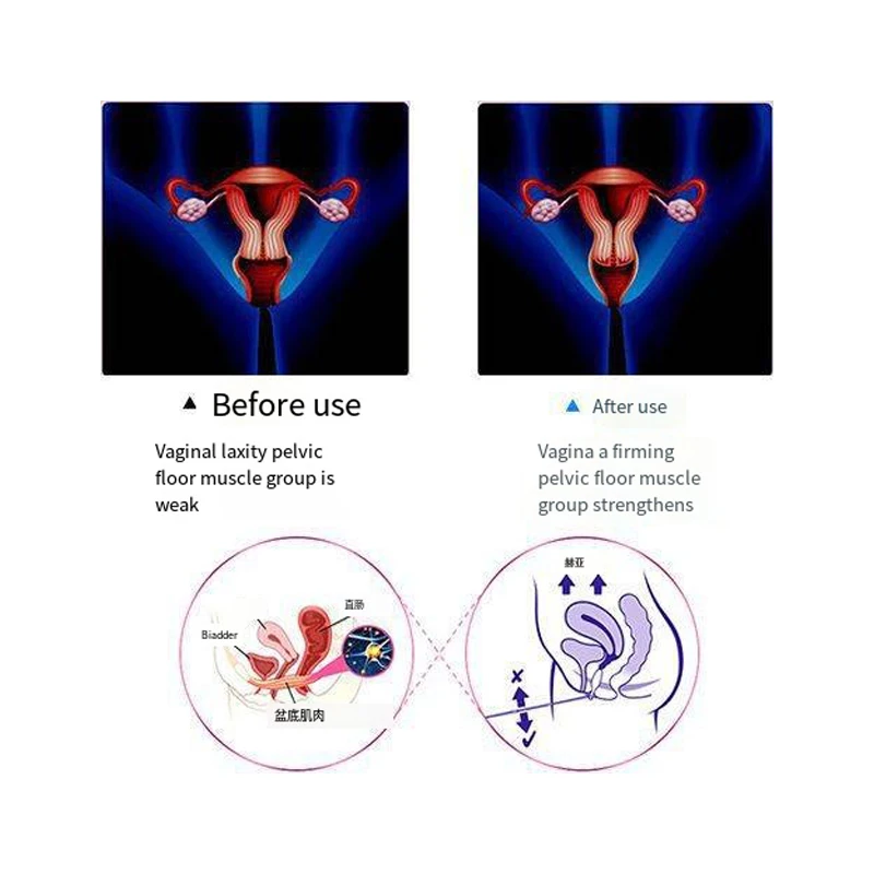 Ćwiczenie trener mięśni dna miednicy Ems mięśnie poporodowe nietrzymanie moczu skurcz pochwy mięsień dna miednicy