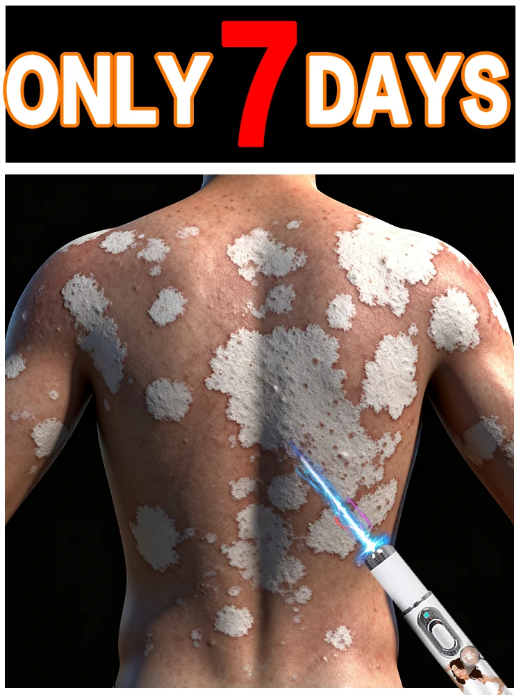 

Vitiligo symptom auxiliary care tool! Blue light special tool with blue pen, convenient, practical and safe