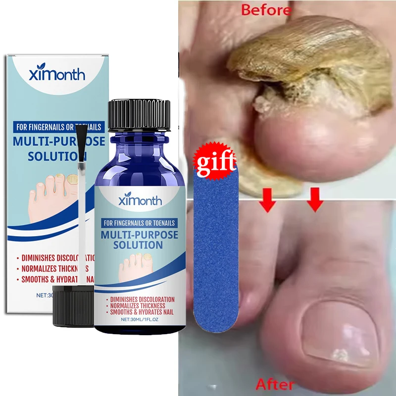 

Сыворотка для лечения грибка ногтей 7Days с имбирем, антибактериальный гель для восстановления ногтей при паронихии и онихомикозе, уход за ногтями на руках и ногах