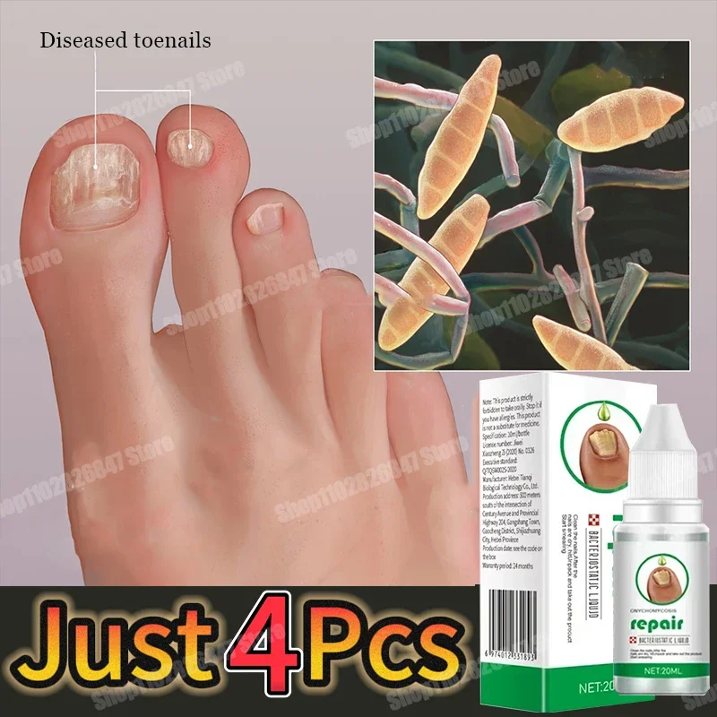 Tratamento de fungos nas unhas, essência para cuidados com os pés, clareamento dos pés, remoção de fungos nas unhas dos pés, gel anti-infecção, paroníquia, onicomicose