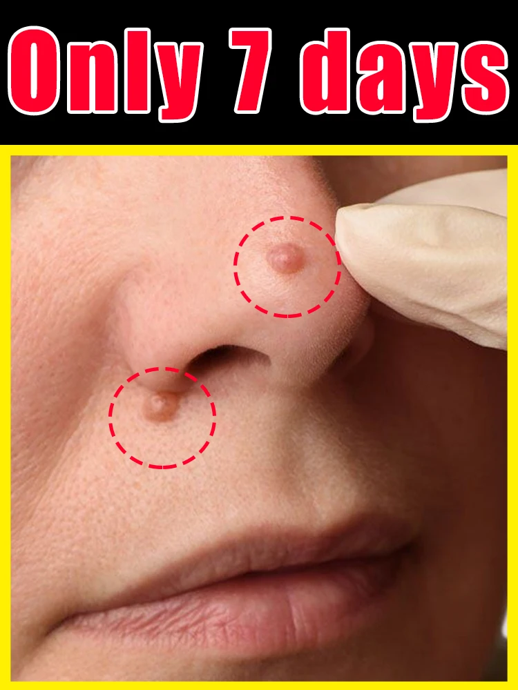 

Wart-free, more confident