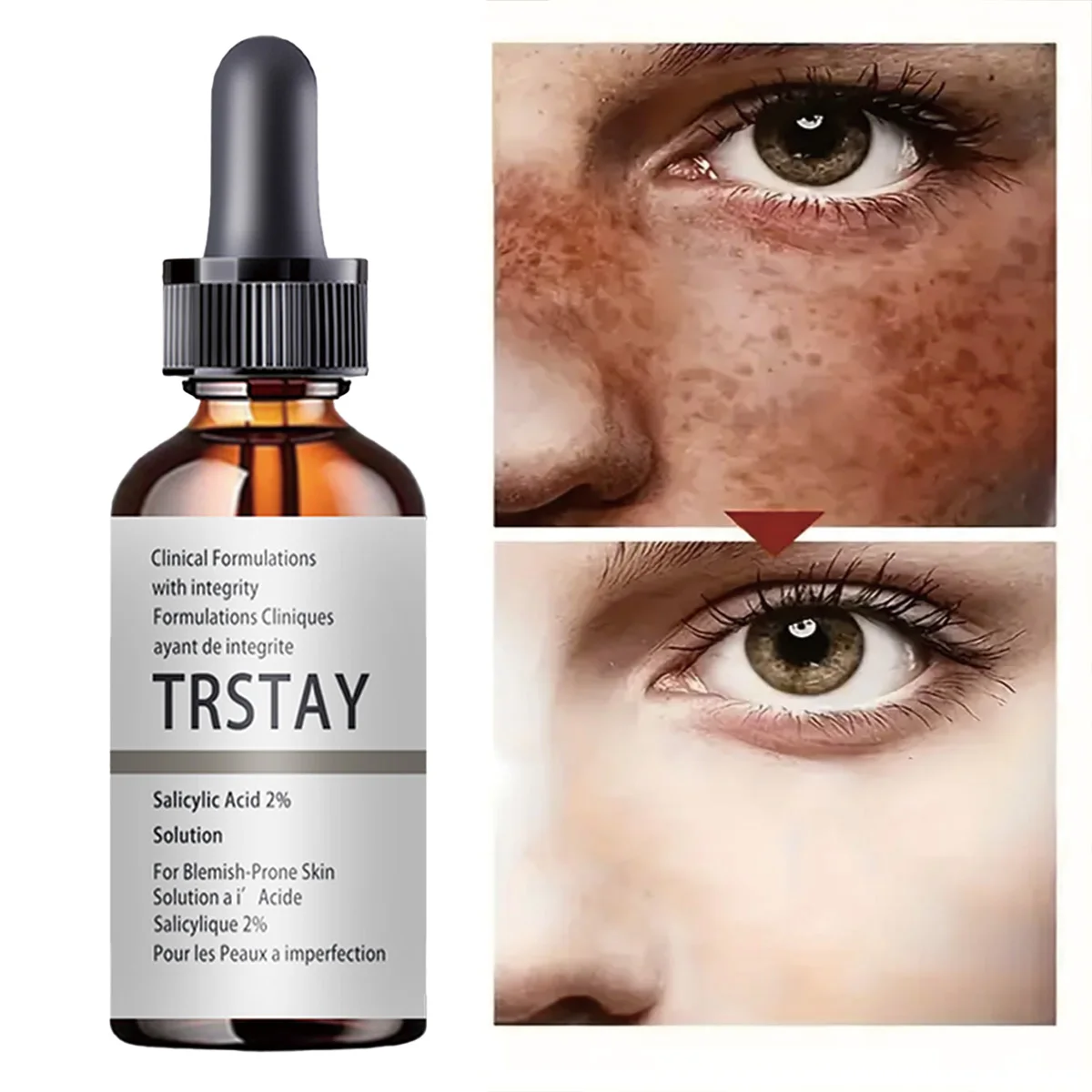 

TRSTAY Салициловая кислота 2% раствора для кожи, склонные веснушки, крем для тела с гидрохлоровой кислотой для ухода за дефектом кожей и беременных