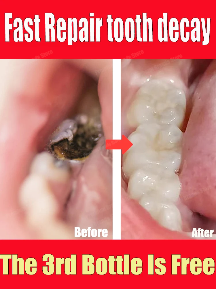 

Tooth Decay Repair All Cavities