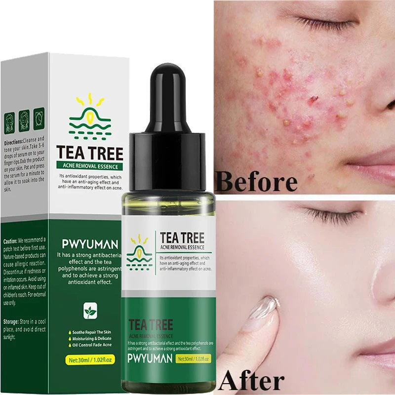 Tea Tree Acne Treatment Face Serum Anti Acne Pimples Deep Cleaning  Pores Essence Firming Smoothing Repair Skin Care Cosmetics