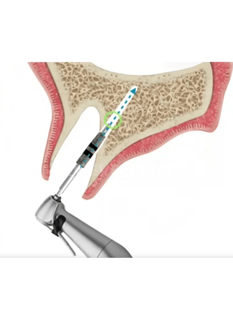 مجموعة أدوات الطرد المركزي PRF CGF الكاملة للأسنان، لوحة زرع من الفولاذ المقاوم للصدأ وصندوق غشاء العظام لجراحة الأسنان