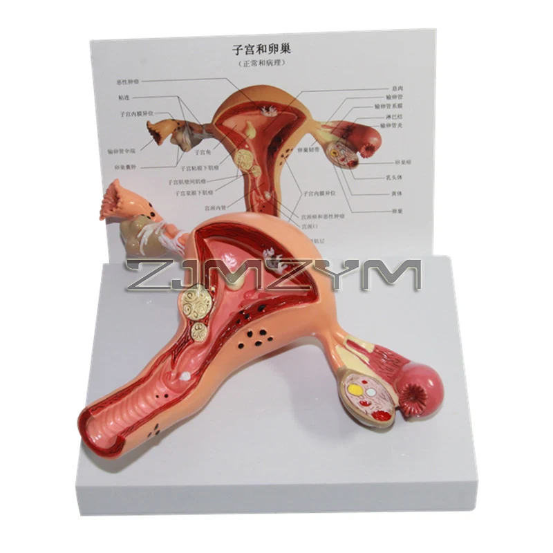 Human Pathological Uterus Ovary Model Cross Section Structure Model Uterus Anatomical Anatomy Female Organ Teach Study Tool